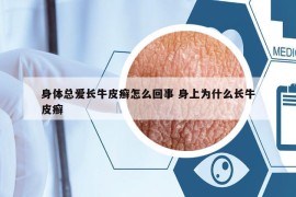 身體總愛(ài)長(zhǎng)牛皮癬怎么回事 身上為什么長(zhǎng)牛皮癬