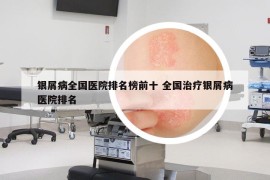 銀屑病全國醫(yī)院排名榜前十 全國治療銀屑病醫(yī)院排名