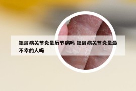 銀屑病關(guān)節(jié)炎是歷節(jié)病嗎 銀屑病關(guān)節(jié)炎是最不幸的人嗎