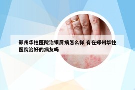 鄭州華柱醫(yī)院治銀屑病怎么樣 有在鄭州華柱醫(yī)院治好的病友嗎