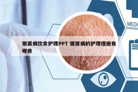 銀屑病飲食護(hù)理PPT 銀屑病的護(hù)理措施有哪些