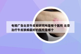 電視廣告北京牛皮癬研究所是哪個醫(yī)院 北京治療牛皮膚癬最好的醫(yī)院是哪個