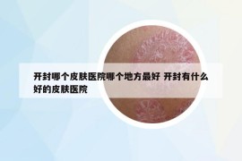 開封哪個(gè)皮膚醫(yī)院哪個(gè)地方最好 開封有什么好的皮膚醫(yī)院