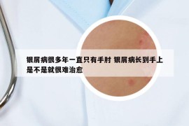 銀屑病很多年一直只有手肘 銀屑病長(zhǎng)到手上是不是就很難治愈