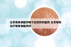 北京銀屑病醫(yī)院哪個比較好的醫(yī)院 北京哪家治療銀屑病醫(yī)院好