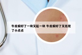 牛皮癬好了一塊又起一塊 牛皮癬好了又出現(xiàn)了小點(diǎn)點(diǎn)