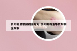 貴陽哪里銀屑病治療好 貴陽哪有治牛皮癬的醫(yī)院啊