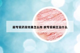 蘚專家藥膏效果怎么樣 膚專家癬王治什么