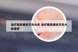 治療銀屑病關節(jié)炎大夫 治療銀屑病關節(jié)炎大夫推薦