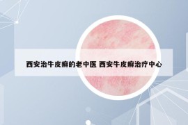 西安治牛皮癬的老中醫(yī) 西安牛皮癬治療中心