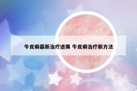 牛皮癬最新治療進展 牛皮癬治療新方法