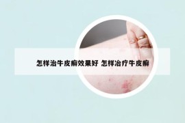 怎樣治牛皮癬效果好 怎樣冶療牛皮癬