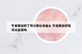 牛皮癬治好了可以用化妝品么 牛皮癬治好后可以染發(fā)嗎