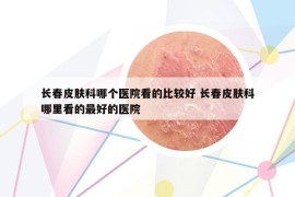 長春皮膚科哪個醫(yī)院看的比較好 長春皮膚科哪里看的最好的醫(yī)院