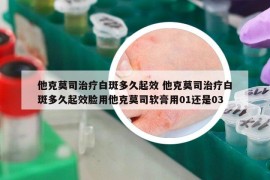 他克莫司治療白斑多久起效 他克莫司治療白斑多久起效臉用他克莫司軟膏用01還是03