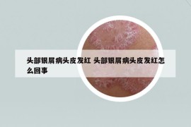頭部銀屑病頭皮發(fā)紅 頭部銀屑病頭皮發(fā)紅怎么回事