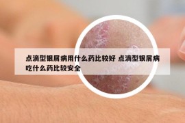 點(diǎn)滴型銀屑病用什么藥比較好 點(diǎn)滴型銀屑病吃什么藥比較安全