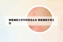 銀屑病找工作不好找怎么辦 銀屑病找不到工作