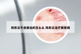 陳彤云牛皮癬治的怎么么 陳彤云治療銀屑病