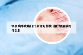銀屑病牛皮癬打什么針好得快 治療銀屑病打什么針