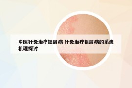 中醫(yī)針灸治療銀屑病 針灸治療銀屑病的系統(tǒng)機(jī)理探討