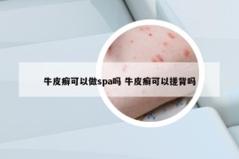 牛皮癬可以做spa嗎 牛皮癬可以搓背嗎