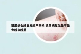 銀屑病會越復(fù)發(fā)越嚴重嗎 銀屑病復(fù)發(fā)是不是會越來越重