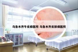 烏魯木齊牛皮癬醫(yī)院 烏魯木齊皮膚病醫(yī)院