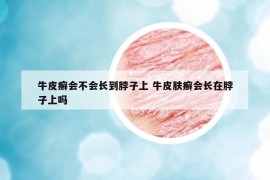 牛皮癬會(huì)不會(huì)長(zhǎng)到脖子上 牛皮膚癬會(huì)長(zhǎng)在脖子上嗎