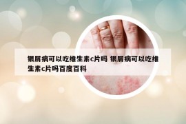 銀屑病可以吃維生素c片嗎 銀屑病可以吃維生素c片嗎百度百科