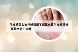 牛皮癬怎么治療好我用了雙氧水莫牛皮癬很疼 雙氧水對(duì)牛皮癬