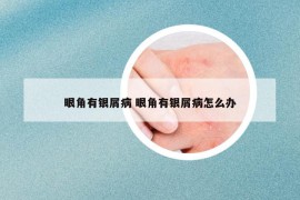 眼角有銀屑病 眼角有銀屑病怎么辦