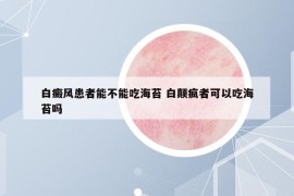 白癜風患者能不能吃海苔 白顛瘋者可以吃海苔嗎