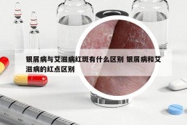 銀屑病與艾滋病紅斑有什么區(qū)別 銀屑病和艾滋病的紅點(diǎn)區(qū)別