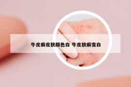 牛皮癬皮膚顏色白 牛皮膚癬變白