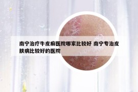 南寧治療牛皮癬醫(yī)院哪家比較好 南寧專治皮膚病比較好的醫(yī)院