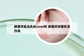 膚霸天能治頭皮xuan嗎 膚霸天抑菌乳膏作用