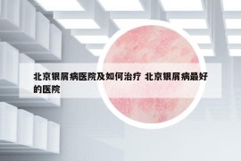北京銀屑病醫(yī)院及如何治療 北京銀屑病最好的醫(yī)院