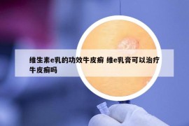維生素e乳的功效牛皮癬 維e乳膏可以治療牛皮癬嗎