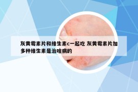 灰黃霉素片和維生素c一起吃 灰黃霉素片加多種維生素是治啥病的