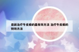目前治療牛皮癬的最有效方法 治療牛皮癬的特效方法