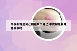 牛皮癬就是自己細(xì)胞攻擊自己 牛皮癬是自身免疫病嗎