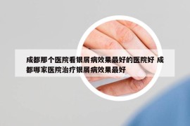 成都那個醫(yī)院看銀屑病效果最好的醫(yī)院好 成都哪家醫(yī)院治療銀屑病效果最好