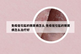 免疫低引起的銀屑病怎么 免疫低引起的銀屑病怎么治療好