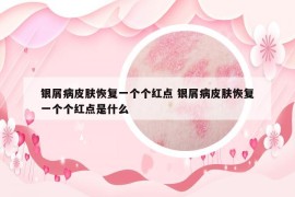 銀屑病皮膚恢復一個個紅點 銀屑病皮膚恢復一個個紅點是什么