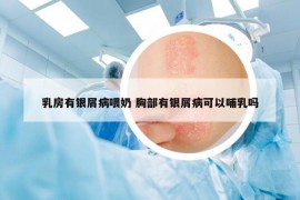 乳房有銀屑病喂奶 胸部有銀屑病可以哺乳嗎