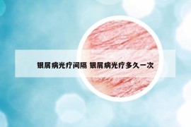 銀屑病光療間隔 銀屑病光療多久一次
