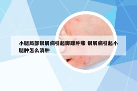 小腿局部銀屑病引起腳踝腫脹 銀屑病引起小腿腫怎么消腫