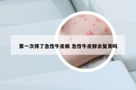 第一次得了急性牛皮癬 急性牛皮鮮會復(fù)發(fā)嗎