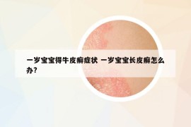 一歲寶寶得牛皮癬癥狀 一歲寶寶長皮癬怎么辦?